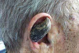 Image result for cornu cutaneum)