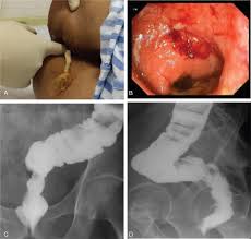 The left lateral position may be uncomfortable for elderly patients. Methods For Assessing Bar Loosening And Anastomotic Leakage A Rectal Download Scientific Diagram