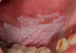 Fra lang avstand fanget nemlig romsonden dawn stadig tydeligere bilder av en uforklarlig, hvit flekk i overflatelandskapet. Leukoplaki Hvit E Flekk Er I Munn Slimhinnen Odontologiskinfo