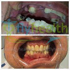 Natural Dental Crowns Before And After Health Dentistvisit Dentalcrownsbeforeandafterfit Dental Crowns Dental Tooth Extraction Food