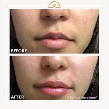 Jan 06, 2018 · the asps 2016 statistics list the following cost per syringe: Juvederm Explore Facebook