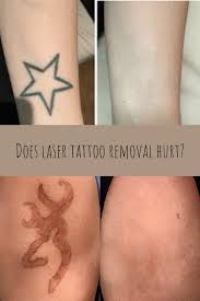Both the picosure™ and picoway® have exponential advanced laser technology for tattoo removal. Does Tattoo Removal Leave A Scar Tattooglee