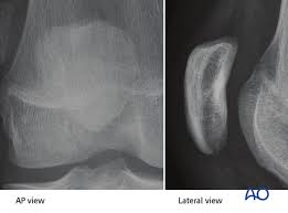 The anterior ligament is the weaker and more vulnerable of the two, which is why it gets injured more often. Partial Articular Medial Sagittal Simple Fracture Ao Ota 34b2 1