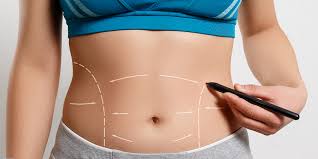 What Are the Benefits of Laser Liposuction