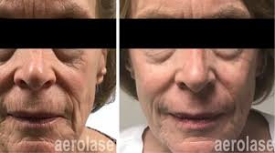 Valley Laser and Skin