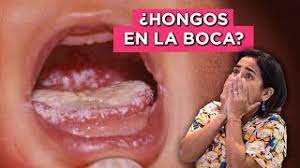 Hongos En La Boca De Un Bebe Candidiasis Que Hacer Por Que Salen Youtube