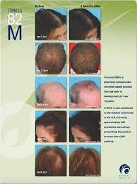Minoxidil is commonly used as an ingredient in hair loss treatment formulas. Compounded Minoxidil Formula 82m Bauman Medical