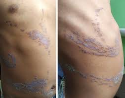 Image result for Linear Dermatitis