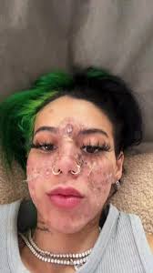 Beasteater Face: The Story Behind the Chemical Burn