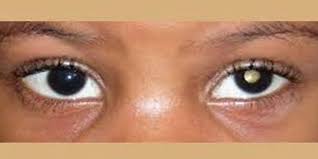 If you're experiencing any of these symptoms, especially if they've persisted over a few weeks, schedule an appointment with. 70 Pc Of Tanzanian Children Die Of Eye Cancer Every Year Expert