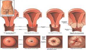 Sedang pap smear dilakukan dalam enam bulan atau. Ini Tanda Tanda Kanser Pangkal Rahim