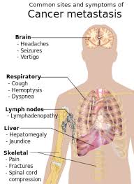 What are the main causes of primary liver cancer? Cancer Signs And Symptoms Wikipedia