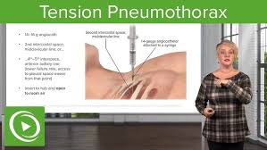 Image result for Open Pneumothorax