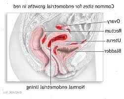 Check spelling or type a new query. Endometriose On