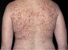 Image result for mastocytosis