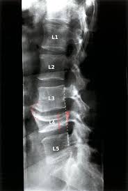 A transverse process fracture at the level of l5 is a surrogate marker of vertical instability of the pelvic fracture due to the attachment of the iliolumbar ligaments. Vertebral Fractures Amboss