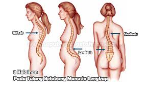 Tulang maupun rangka tubuh sangat penting pada setiap orang. 3 Kelainan Pada Tulang Belakang Manusia Pembahasan Lengkap
