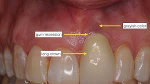 How you can reverse it. Receding Gum Tissue After Dental Implant Treatments Receding Gum Tissue After Dental Implant Treatments Kazemi Oral Surgery Facialart Com