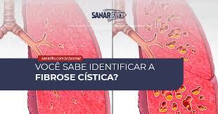 A fibrose quística, cujo nome deriva do aspeto quístico e fibroso que o pâncreas adquire com a doença, é uma doença hereditária e progressiva causada por alterações num determinado gene. Fibrose Cistica Sintomas Diagnostico E Tratamento Sanar Medicina