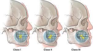 Also known as corrective jaw surgery or simply jaw surgery, is surgery designed to correct conditions of the jaw and lower face related to structure,. Aesthetic Orthognathic Surgery Plastic Surgery Key