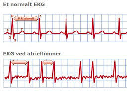 Og findes kærlighed kun i tosomheden? Hjerteflimmer Seniorfitness Blog