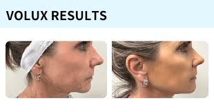 Sonterra Dermatology entre los primeros en obtener Volux Filler