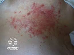 Image result for Candidiasis under breasts