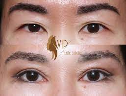 Incisional Upper Blepharoplasty By Vip Plastic Surgery Dr Andrew K Choi Asian Blepharoplasty Commonly Termed Double Eyelid Surgery Is A Procedure That Cr