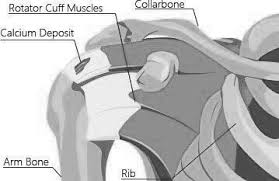Image result for Rotator Cuff Calcification