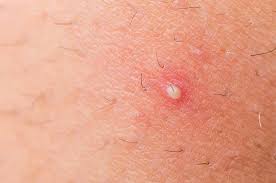 I have a weird dark bump on my elbow. How To Get Rid Of Prevent Ingrown Hairs Treatment Guide