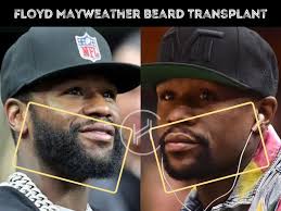 Floyd Mayweather Hair Transplant