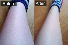 How To Get Rid Of Strawberry Legs Fast 3 Simple Steps Ingrown Hair Remedies Strawberry Legs Ingrown Hair