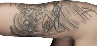 Tattoos Risiken Und Moglichkeiten Der Entfernung