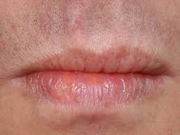 Herpes Was Hilft Gegen Die Schmerzenden Blaschen