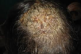 Image result for Tinea Capitis