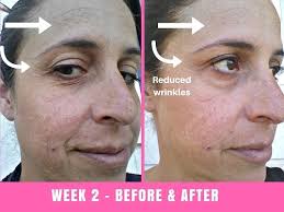 But the science behind the neutrogena light therapy acne mask is entirely legit. Project E Beauty Led Face Mask Before And After 30 Days