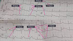Pada st elevasi otot yang infark meliputi otot jantung dalam sampai yang terluar (disebut transmural) sedangkan pada st depresi otot yang kena infark hanya meliputi otot jantung bagian dalam (subendocardial). Kurniawan Prakoso Ø¹Ù„Ù‰ ØªÙˆÙŠØªØ± 7 Wpw Pre Eksitasi Ditandai Dengan Pr Interval Pendek Lt 120 Ms Delta Wave Perubahan St Segmen Berlawanan Dengan Aksis Qrs Discordant Jadi Kalo Qrs Nya Dominan Defleksi Negatif St
