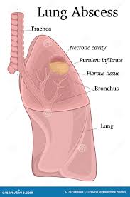 Image result for Lung Abscess
