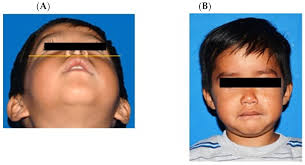 Surgical Treatment of Cranial Fasciitis in an Atypical Maxillary Region of  a Pediatric Patient: A Case Report