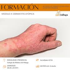 Image result for dermatitis contacta toxica