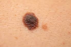 Usuwanie pieprzyków za pomocą tradycyjnych i innowacyjnych metod.  Chirurgia, krioterapia, laseroterapia, elektrokoagulacja | WP abcZdrowie