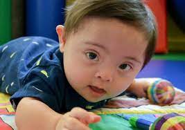 El cromosoma 21 extra causa las características físicas y los desafíos del desarrollo que se pueden presentar en las. Sindrome De Down Que Es Causas Diagnostico Sintomas