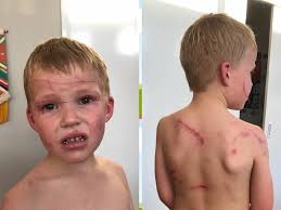 Valla Beach boy Lewis Dyer attacked by a kangaroo