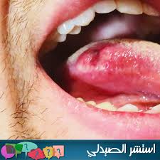 أي أين المهرب ؟ قال الشاعر :أين المفر والكباش تنتطحوأي كبش حاد عنها يفتضحالماوردي Ø£Ø³ØªØ´ÙŠØ± Ø§Ù„ØµÙŠØ¯Ù„ÙŠ Ø­Ø¨ÙˆØ¨ Ø§Ù„Ù„Ø³Ø§Ù† Ø­Ø¨ÙˆØ¨ Ø§Ù„Ù„Ø³Ø§Ù† Ø¨Ø§Ù„Ø¥Ù†Ø¬Ù„ÙŠØ²ÙŠØ© Facebook