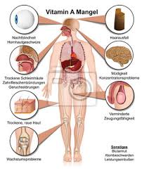 Vitamina D Mangel Anzeichen Und Symptome Ilustracao Vetorial Pinturas Para A Parede Quadros Esclerose Alta Pressao Arterial Escassez Myloview Com Br
