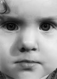 Nasoalveolar molding for infants born with clefts of the lip, alveolus, and  palate