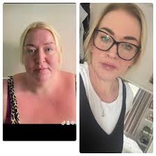 Had bypass done 5 weeks ago at St Richards hospital Chichester. Was only in  over night, have recovered great.