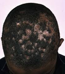 Image result for Tinea Capitis