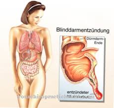 Sakit kepalas sebelah kiri memang menjadi salah satu indikasi adanya penyakit lain di dalam tubuh anda. Appendectomy Struktur Fungsi Penyakit Anatomi