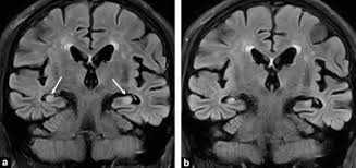 You also might see things that aren't there, called hallucinations. Early Onset Dementias Specific Etiologies And Contribution Of Mri Sciencedirect